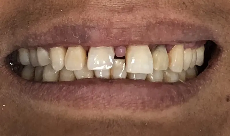 Dental Bridge Cases 4